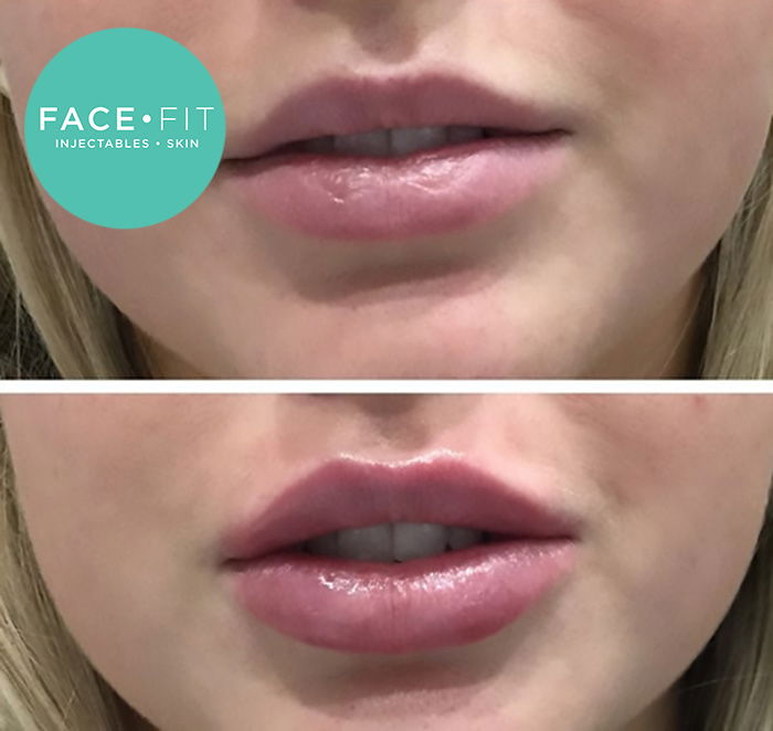 lip injections before and after 1ml