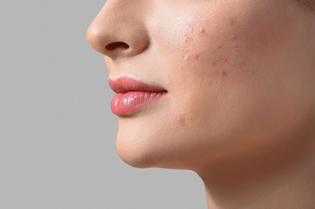 Closeup of woman with mild acne