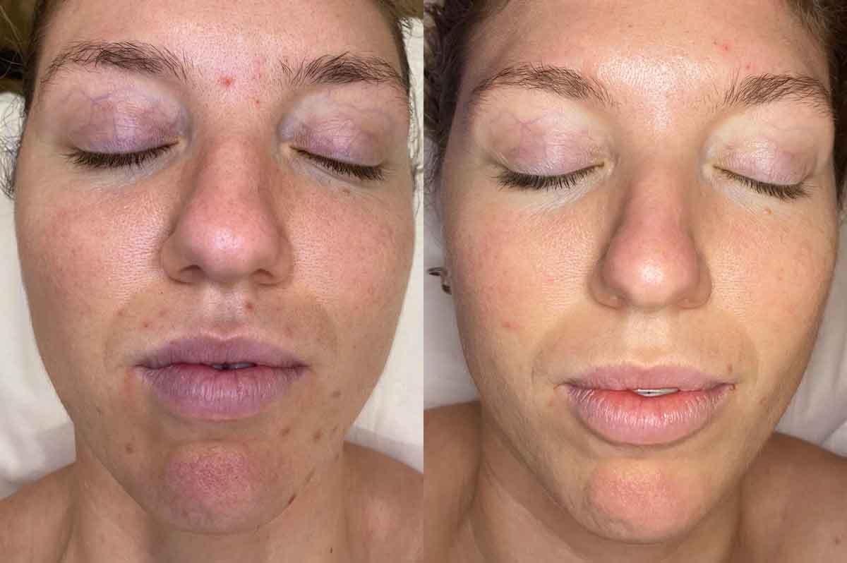 Managing Hormonal Breakouts with Face Fit - Ash's before and after photo