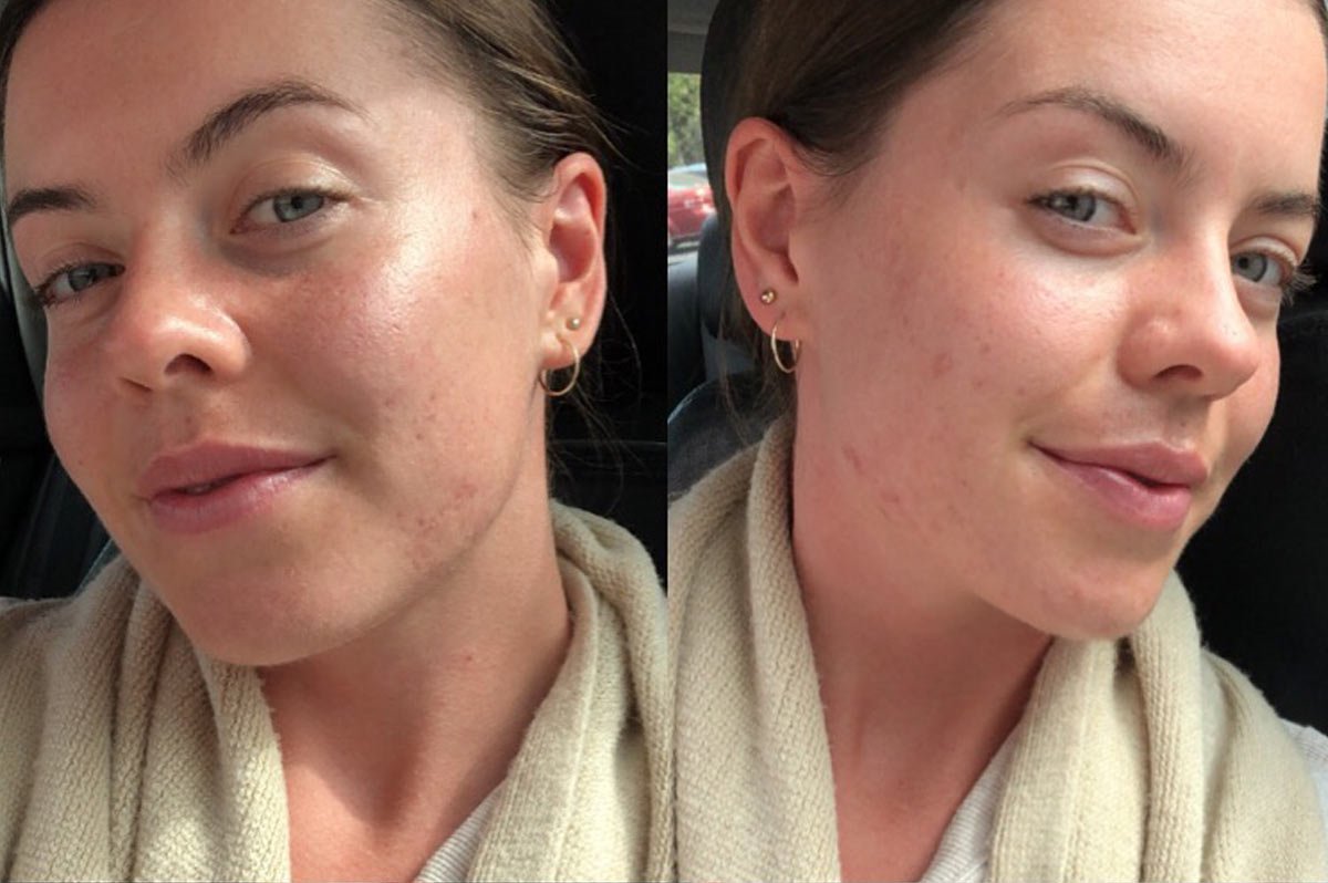 Naturopath Evie's after acne results